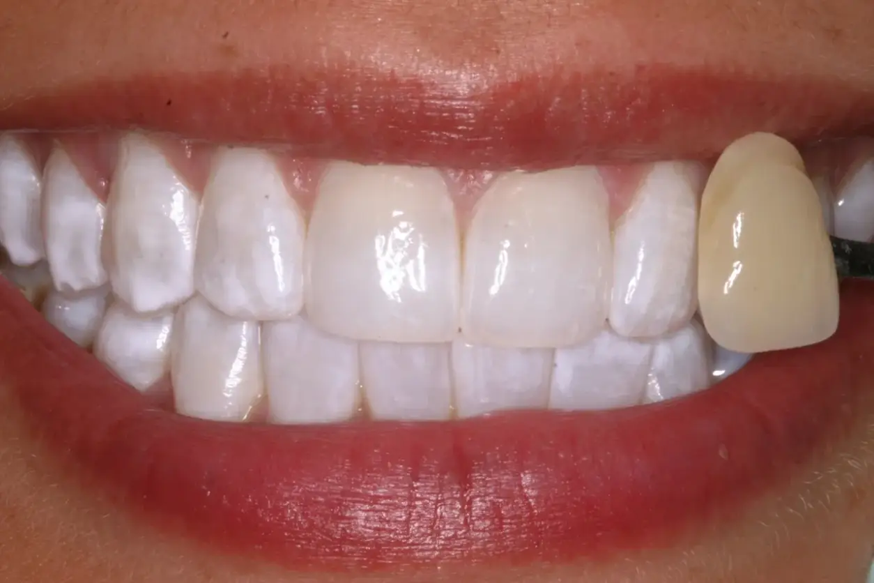 A close up of the teeth with yellow tooth paste on them