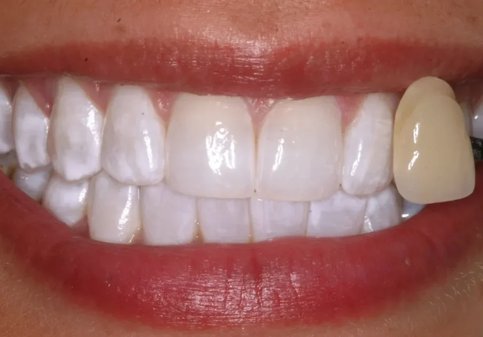 A close up of the teeth with yellow tooth paste on them